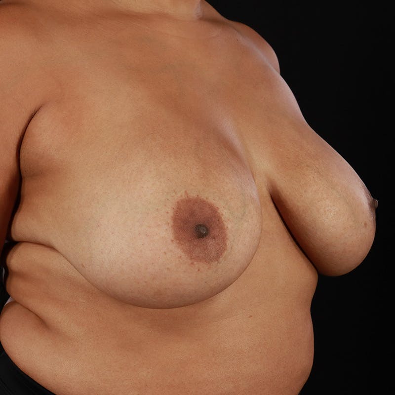 Breast Explant with Lift Before & After Gallery - Patient 584581 - Image 3
