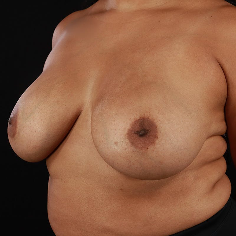 Breast Explant with Lift Before & After Gallery - Patient 584581 - Image 7
