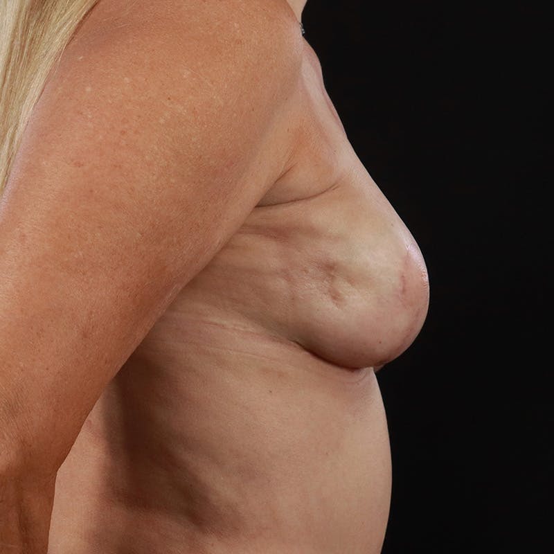 Breast Reconstruction Before & After Gallery - Patient 152430 - Image 6