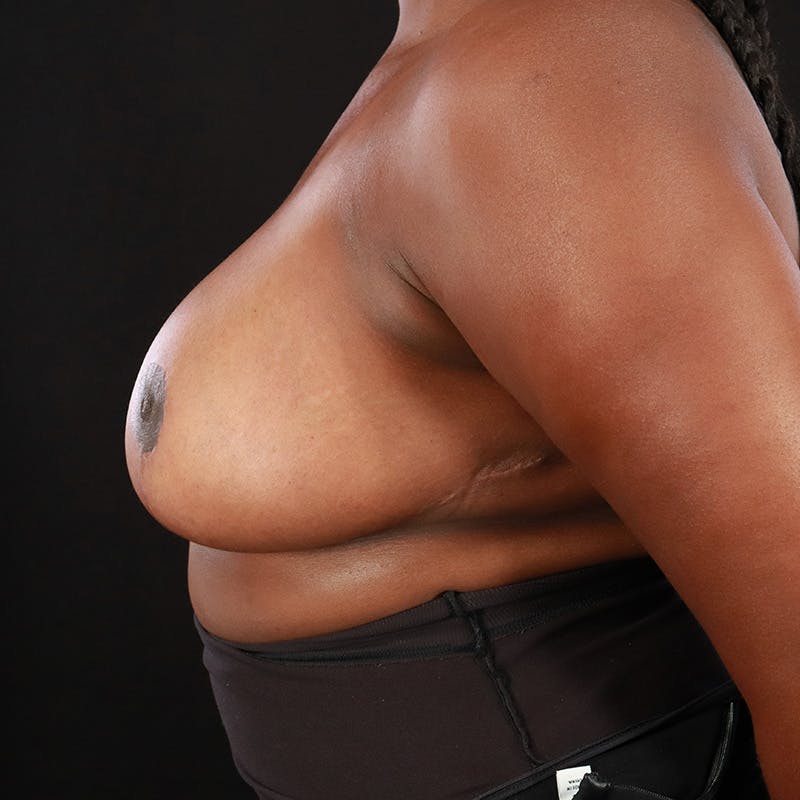 Breast Reduction Before & After Gallery - Patient 395048 - Image 10