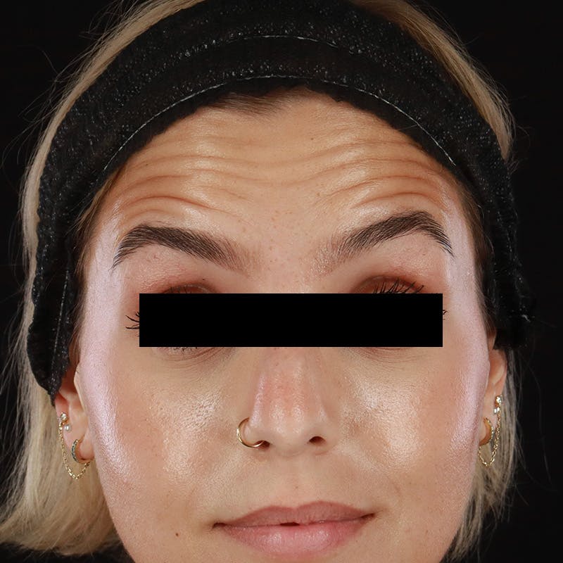 Botox/Dysport/Jeuveau Before & After Gallery - Patient 106861 - Image 1
