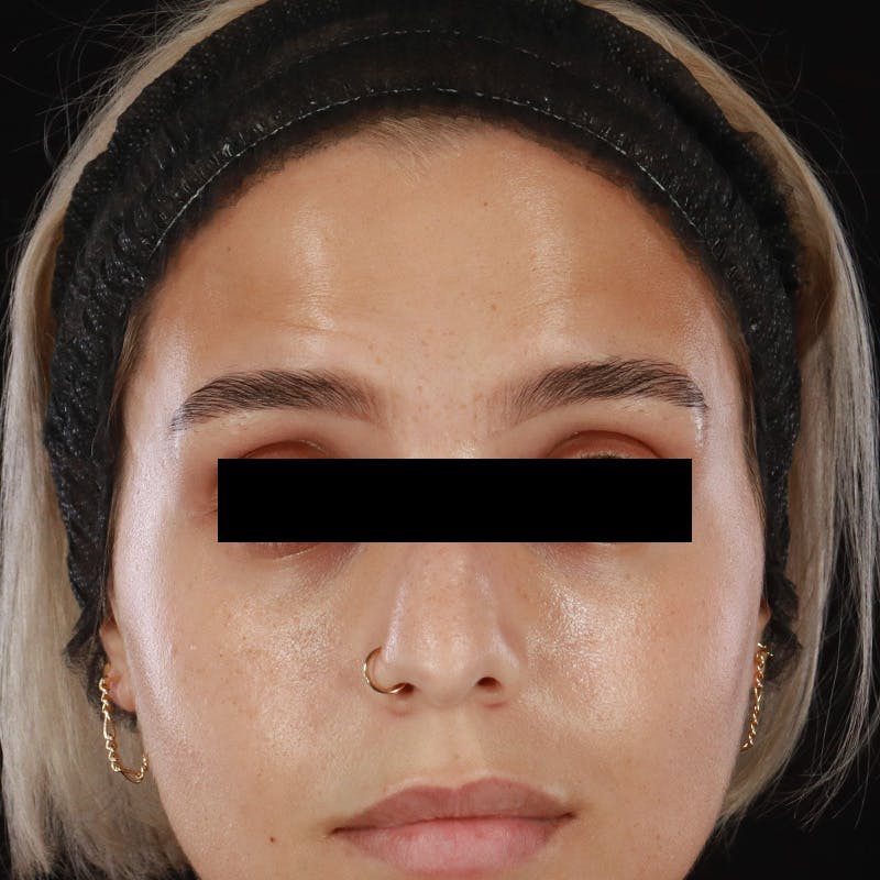 Botox/Dysport/Jeuveau Before & After Gallery - Patient 106861 - Image 2