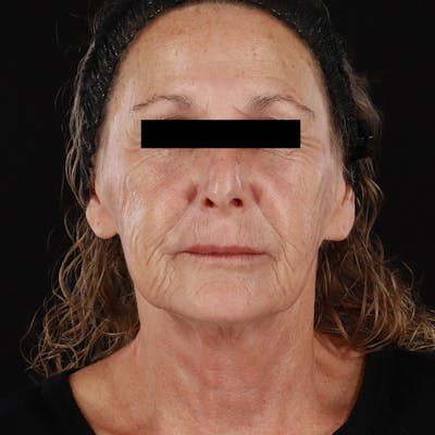 HALO™ Laser Treatment Before & After Gallery - Patient 129374 - Image 1