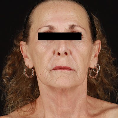 HALO™ Laser Treatment Before & After Gallery - Patient 129374 - Image 2