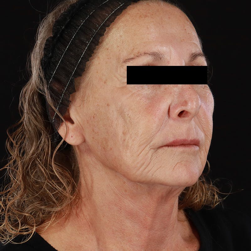 HALO™ Laser Treatment Before & After Gallery - Patient 129374 - Image 3