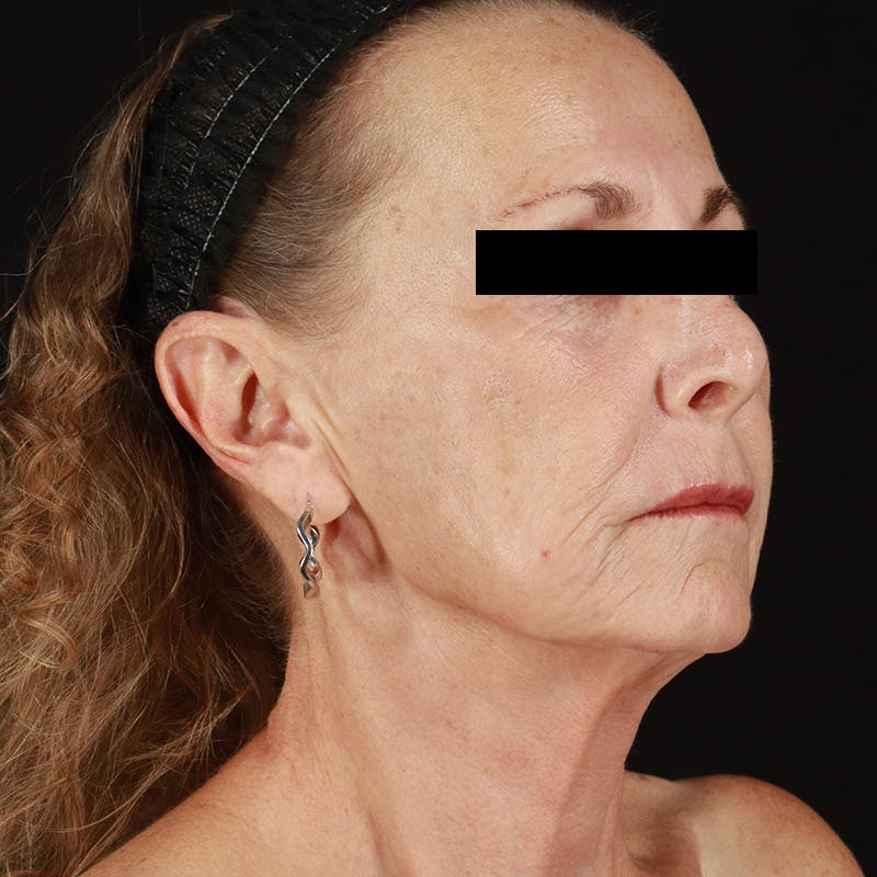 HALO™ Laser Treatment Before & After Gallery - Patient 129374 - Image 4