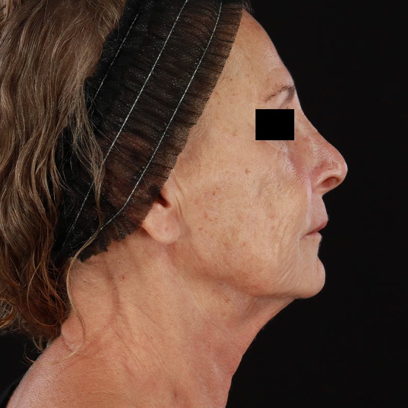 HALO™ Laser Treatment Before & After Gallery - Patient 129374 - Image 5