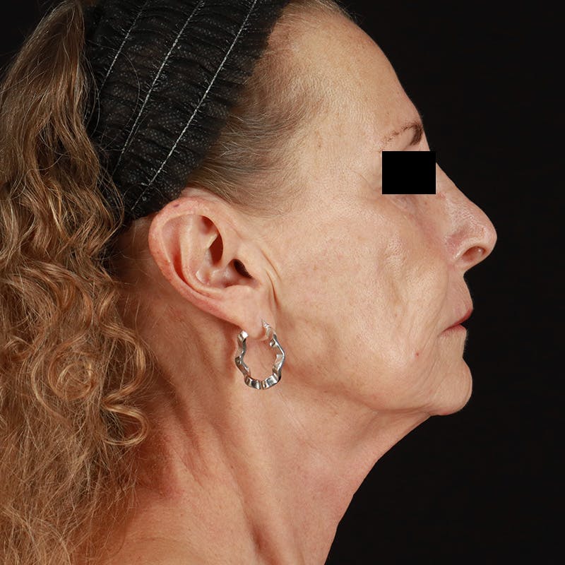 HALO™ Laser Treatment Before & After Gallery - Patient 129374 - Image 6