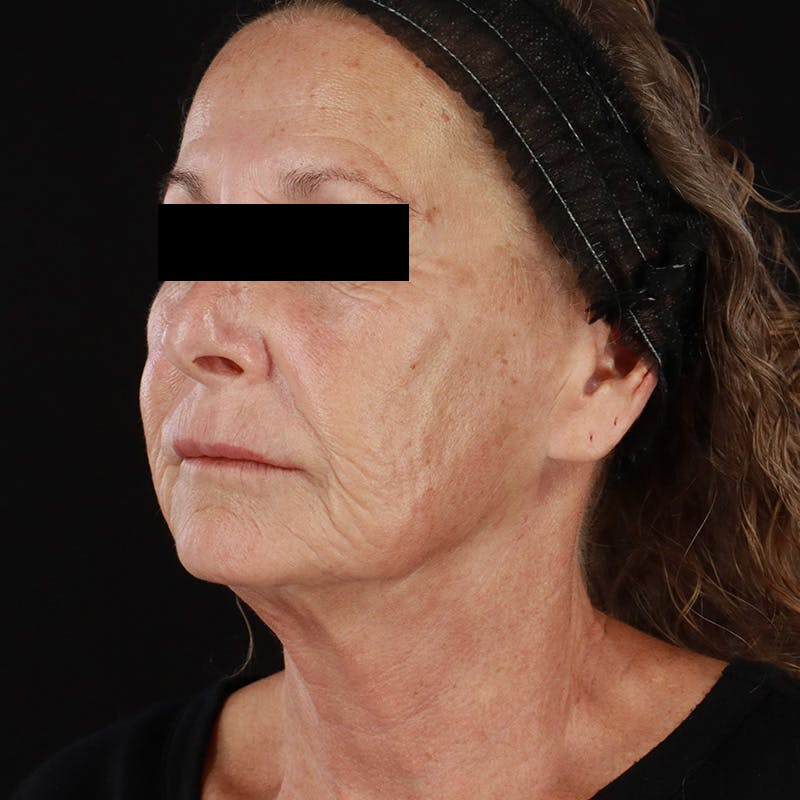 HALO™ Laser Treatment Before & After Gallery - Patient 129374 - Image 7