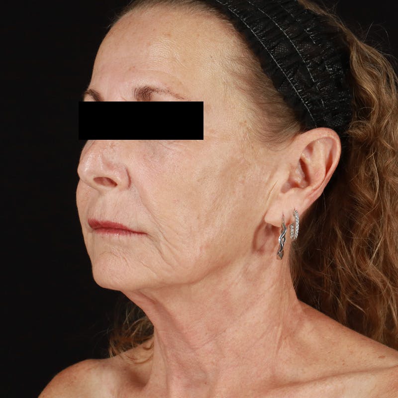 HALO™ Laser Treatment Before & After Gallery - Patient 129374 - Image 8