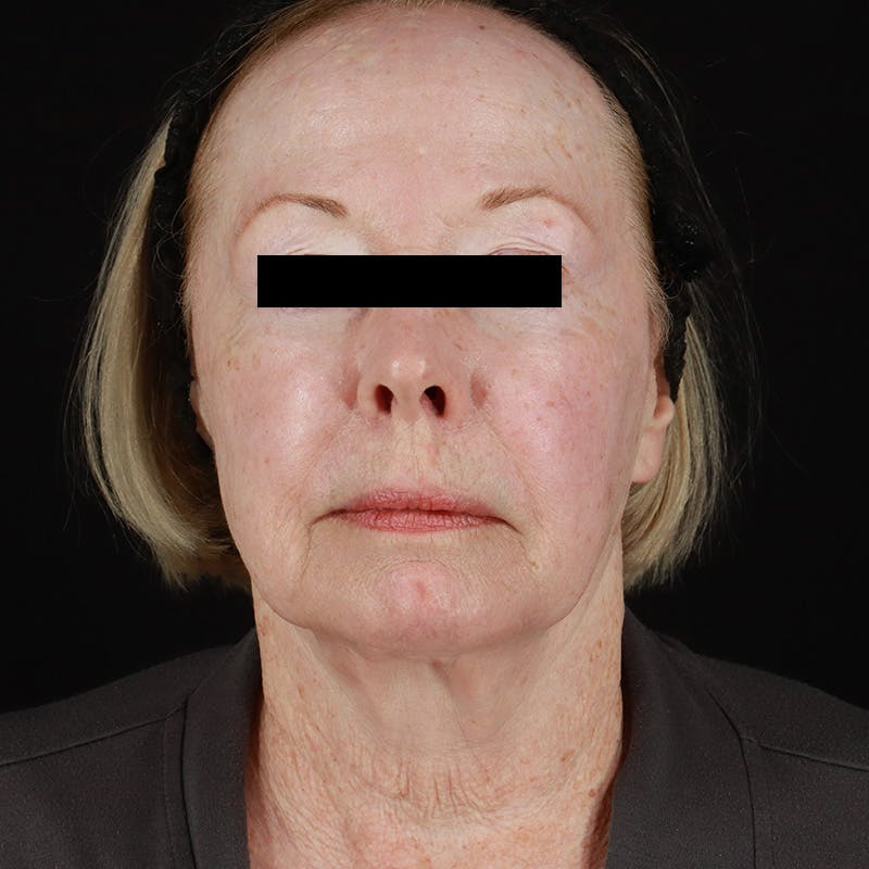 HALO™ Laser Treatment Before & After Gallery - Patient 538430 - Image 1