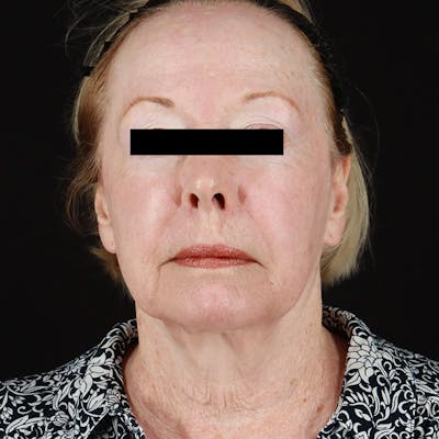 HALO™ Laser Treatment Before & After Gallery - Patient 538430 - Image 2