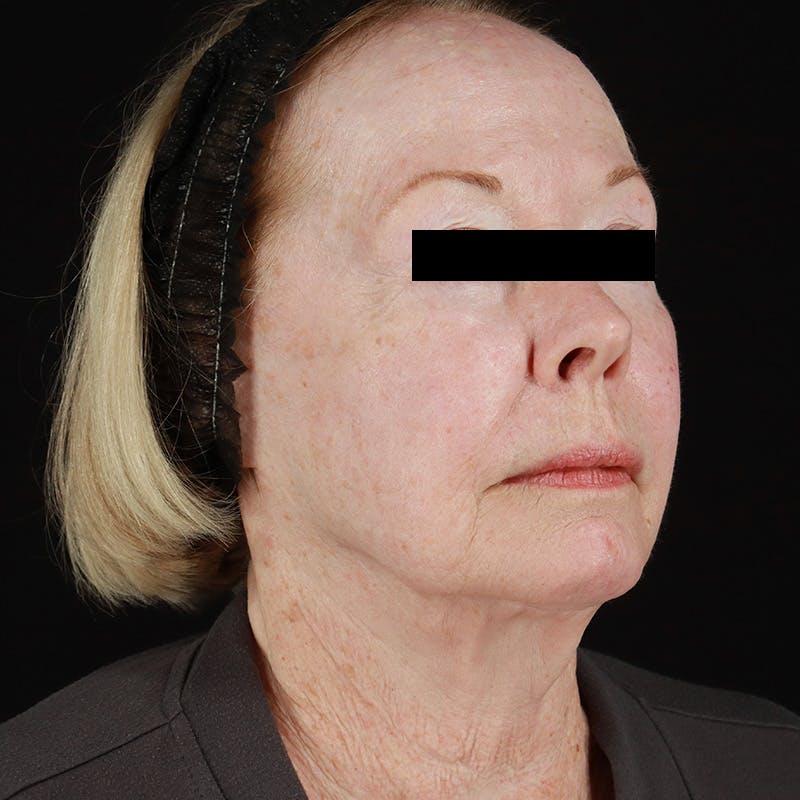 HALO™ Laser Treatment Before & After Gallery - Patient 538430 - Image 3