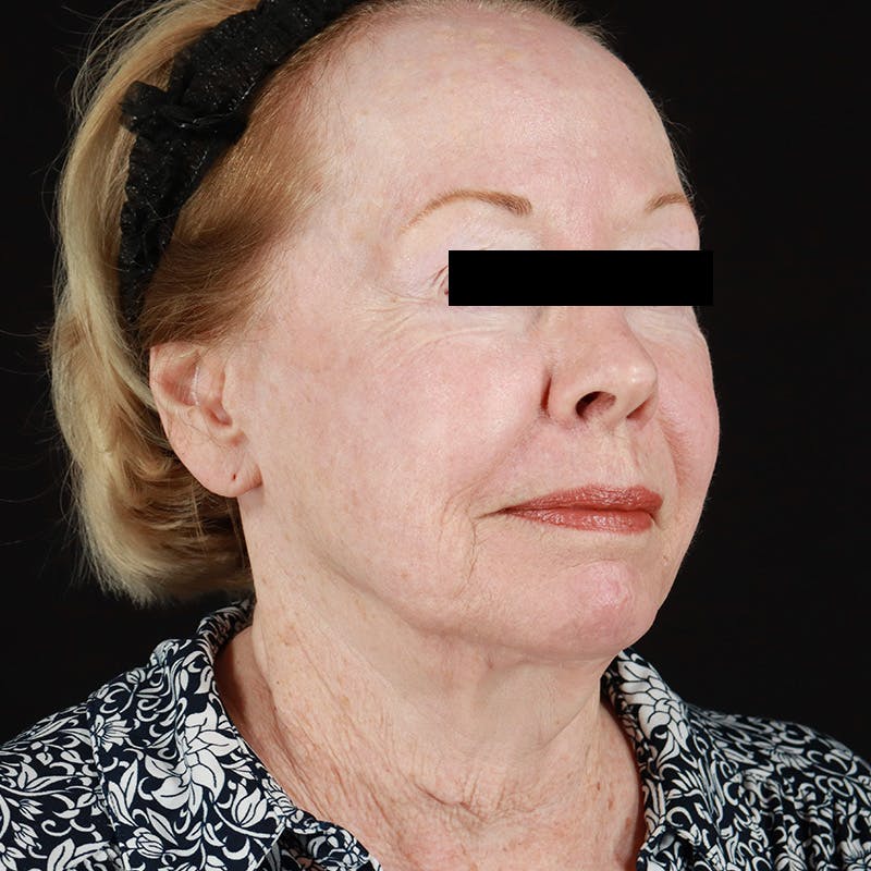 HALO™ Laser Treatment Before & After Gallery - Patient 538430 - Image 4