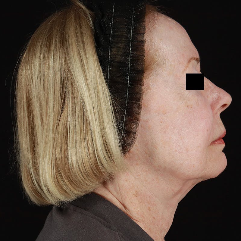 HALO™ Laser Treatment Before & After Gallery - Patient 538430 - Image 5