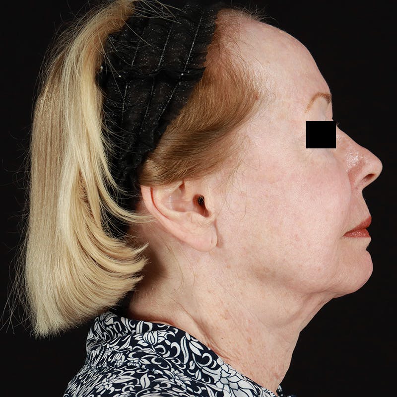 HALO™ Laser Treatment Before & After Gallery - Patient 538430 - Image 6