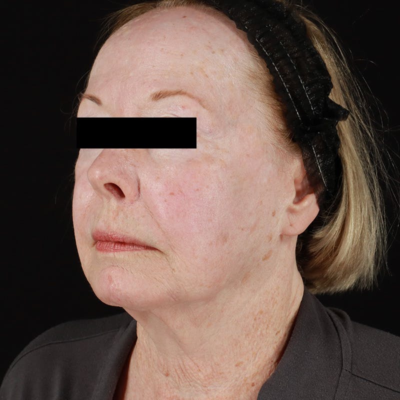 HALO™ Laser Treatment Before & After Gallery - Patient 538430 - Image 7