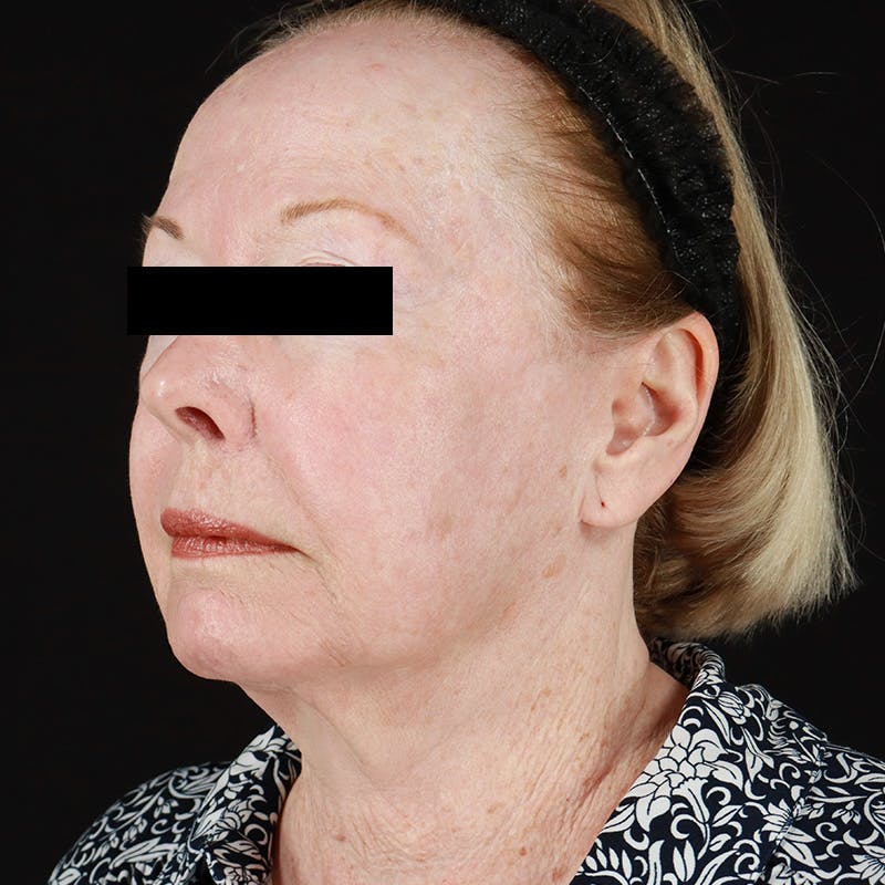 HALO™ Laser Treatment Before & After Gallery - Patient 538430 - Image 8
