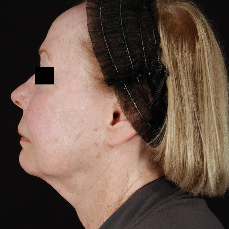 HALO™ Laser Treatment Before & After Gallery - Patient 538430 - Image 9