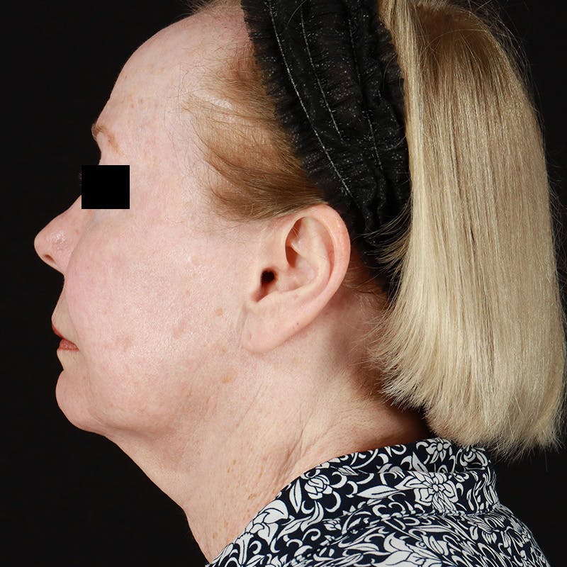 HALO™ Laser Treatment Before & After Gallery - Patient 538430 - Image 10