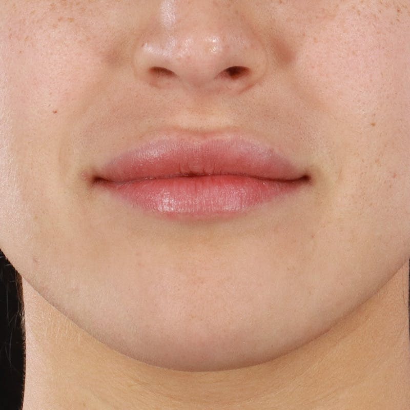 Dermal Fillers Before & After Gallery - Patient 844292 - Image 1