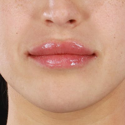 Dermal Fillers Before & After Gallery - Patient 844292 - Image 2