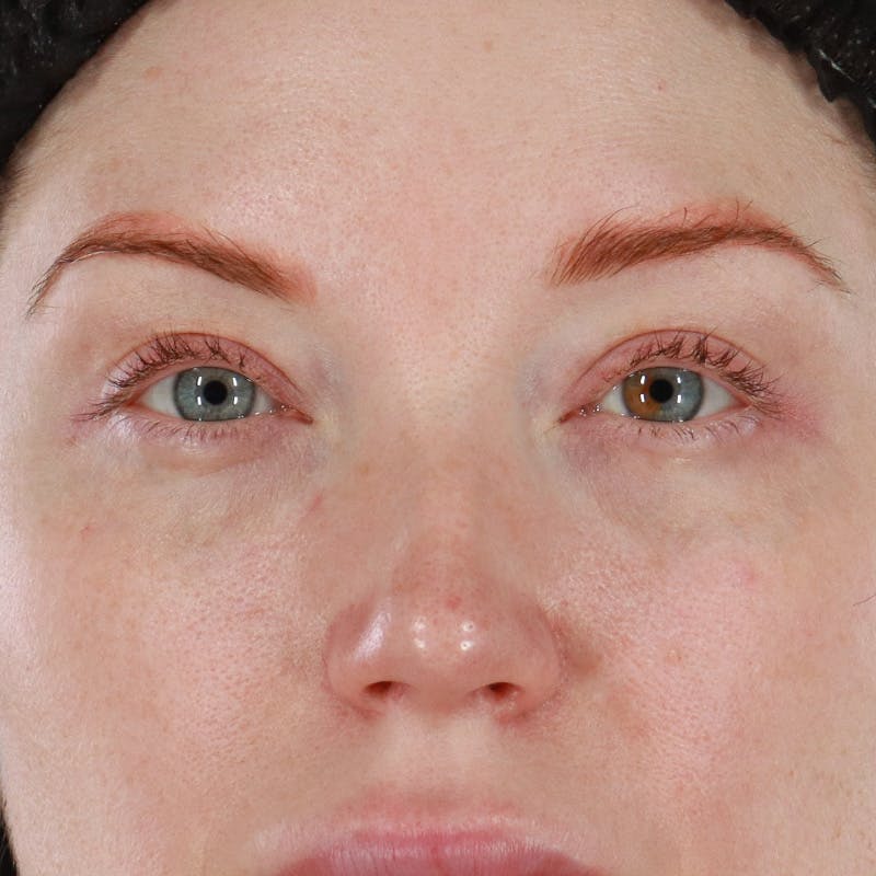 Dermal Fillers Before & After Gallery - Patient 347949 - Image 1