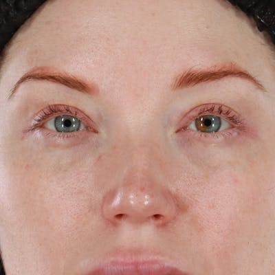Dermal Fillers Before & After Gallery - Patient 347949 - Image 1