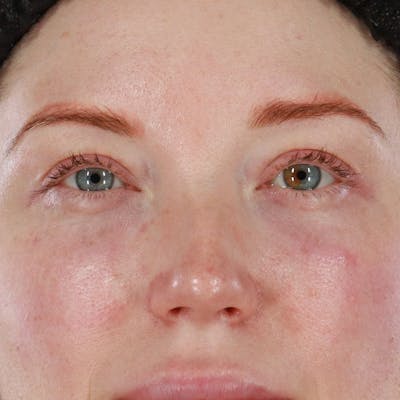 Dermal Fillers Before & After Gallery - Patient 347949 - Image 2