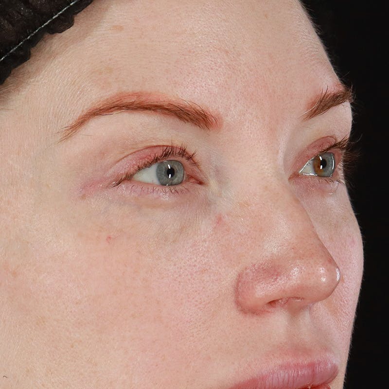 Dermal Fillers Before & After Gallery - Patient 347949 - Image 3