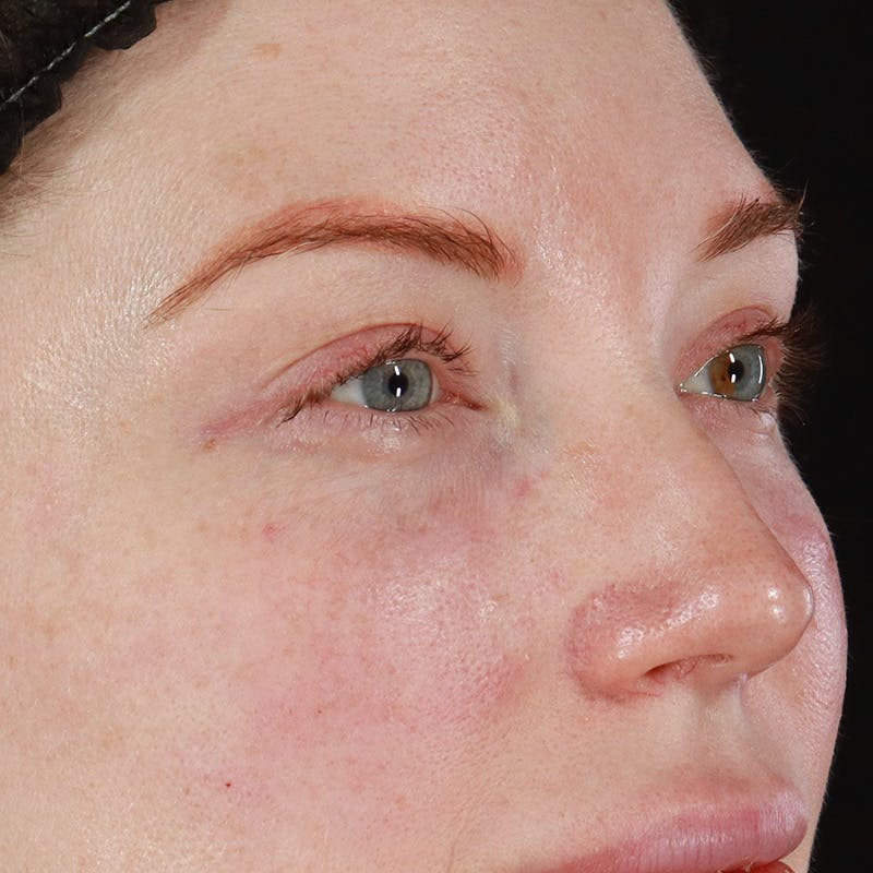 Dermal Fillers Before & After Gallery - Patient 347949 - Image 4