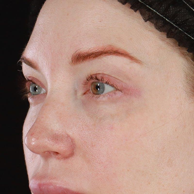 Dermal Fillers Before & After Gallery - Patient 347949 - Image 5