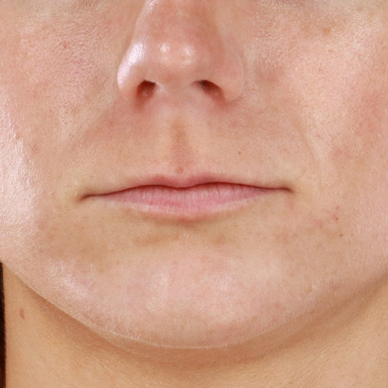 Dermal Fillers Before & After Gallery - Patient 266815 - Image 1