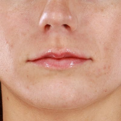Dermal Fillers Before & After Gallery - Patient 266815 - Image 2