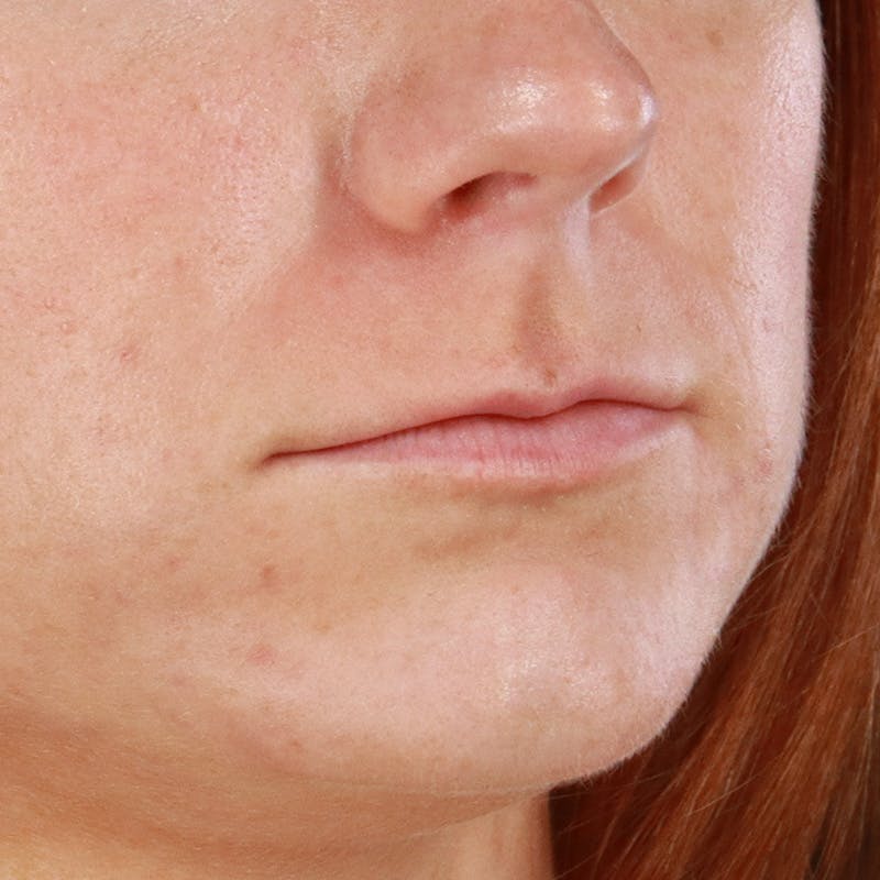 Dermal Fillers Before & After Gallery - Patient 266815 - Image 3