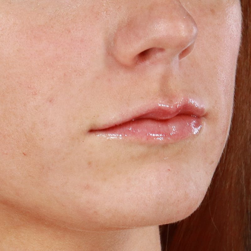 Dermal Fillers Before & After Gallery - Patient 266815 - Image 4