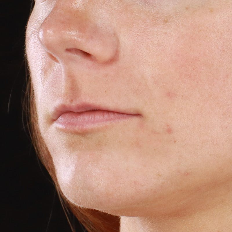 Dermal Fillers Before & After Gallery - Patient 266815 - Image 5