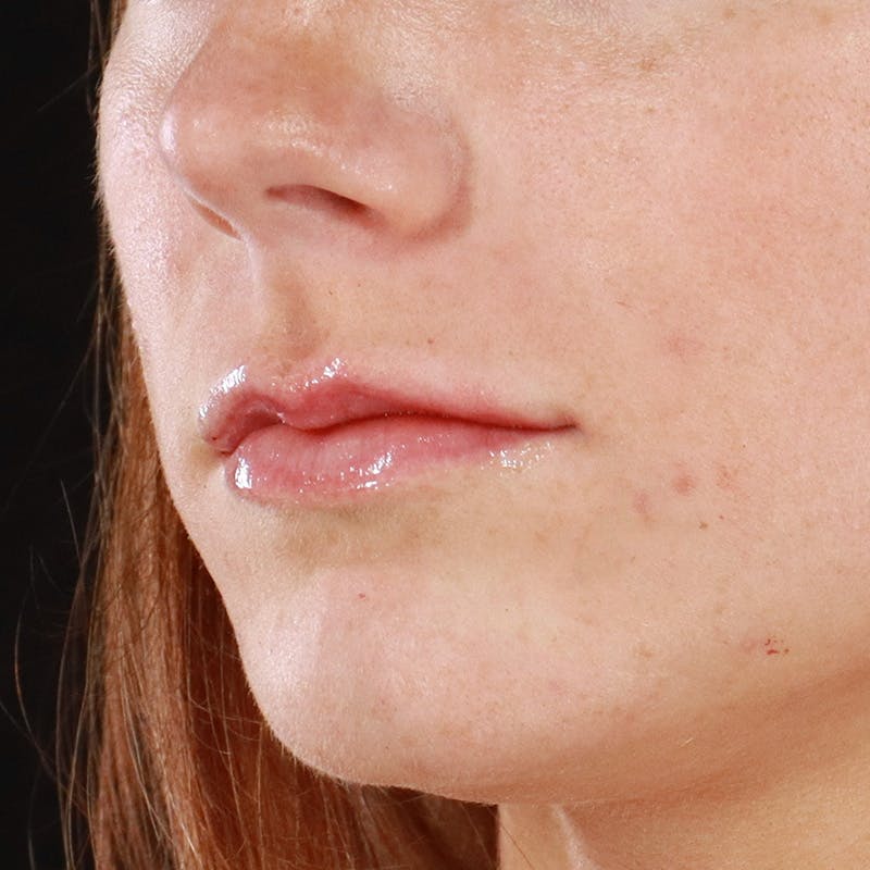 Dermal Fillers Before & After Gallery - Patient 266815 - Image 6