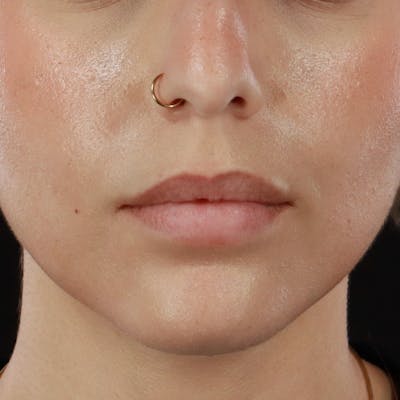 Dermal Fillers Before & After Gallery - Patient 107761 - Image 1