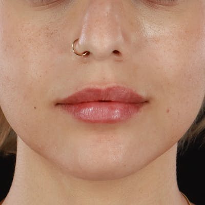 Dermal Fillers Before & After Gallery - Patient 107761 - Image 2