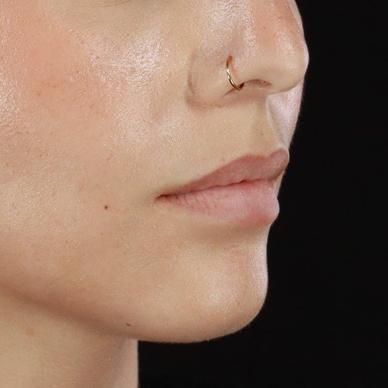 Dermal Fillers Before & After Gallery - Patient 107761 - Image 3