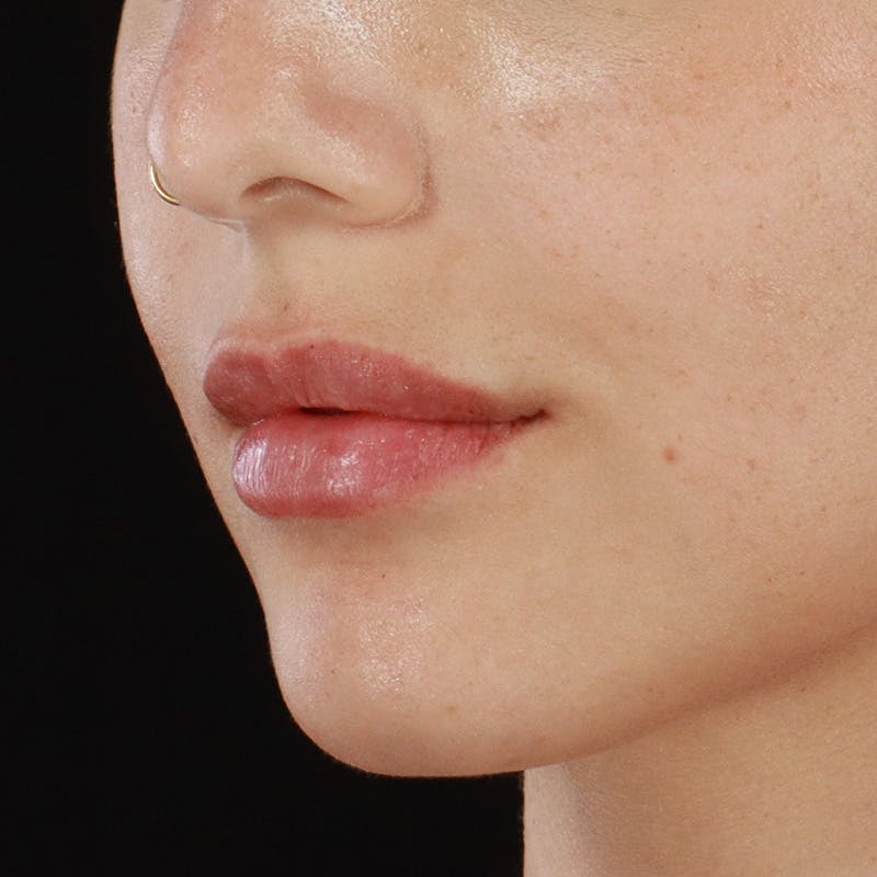 Dermal Fillers Before & After Gallery - Patient 107761 - Image 6