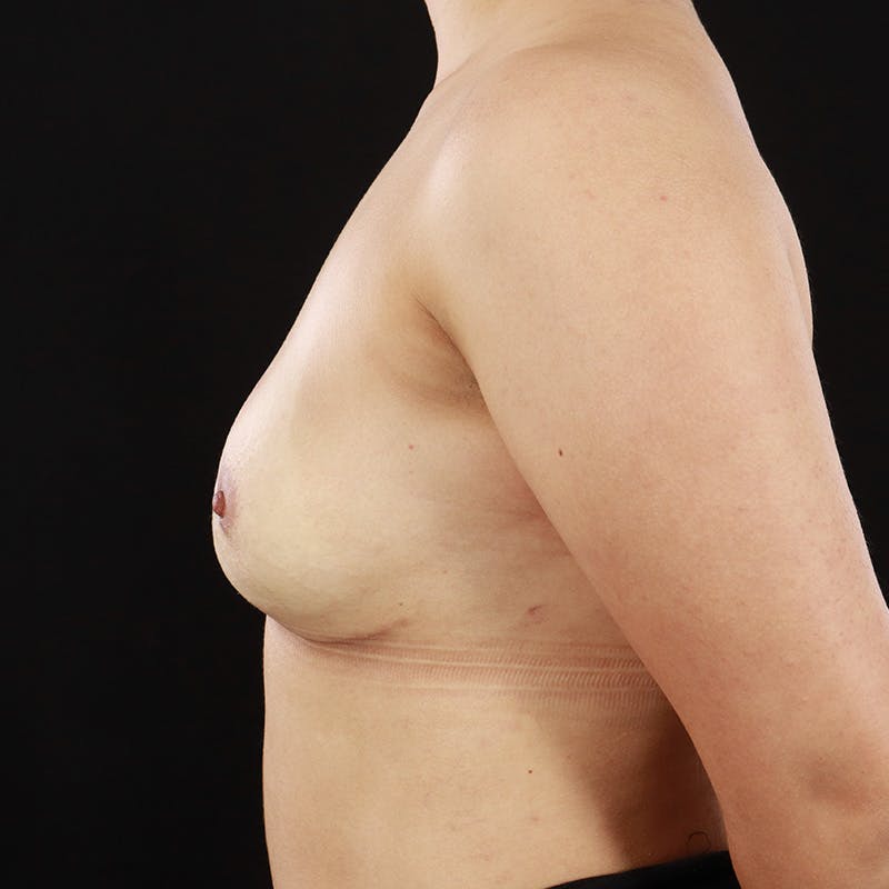 Breast Explant Before & After Gallery - Patient 111745 - Image 10
