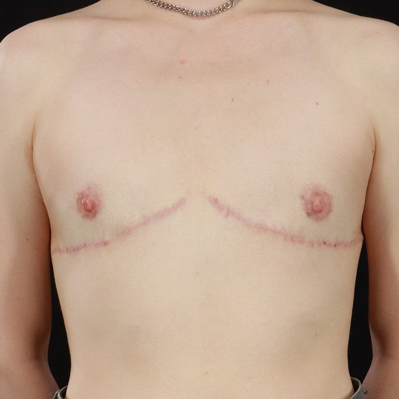 Transgender Top Surgery Before & After Gallery - Patient 309178 - Image 2