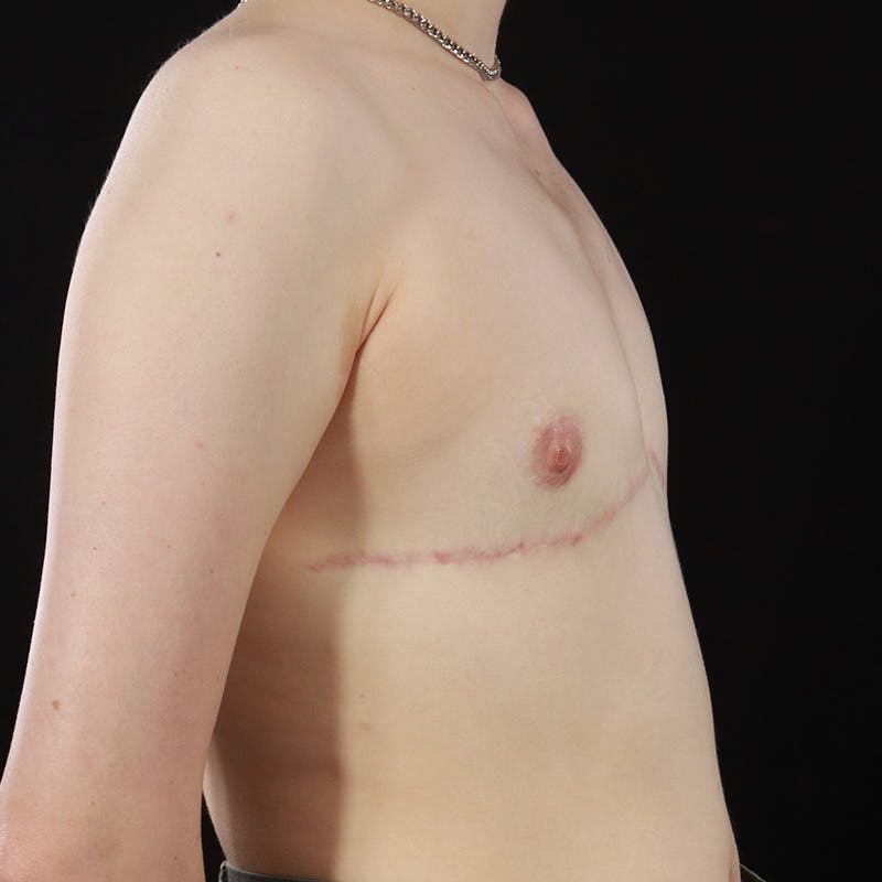 Transgender Top Surgery Before & After Gallery - Patient 309178 - Image 6