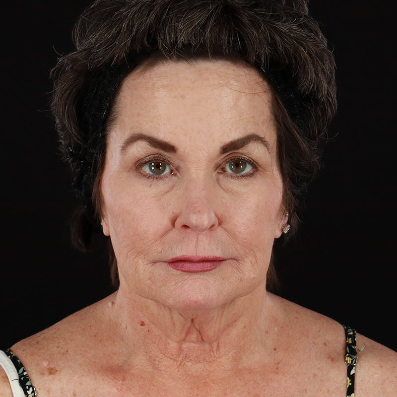 Neck Lift Before & After Gallery - Patient 211207 - Image 3