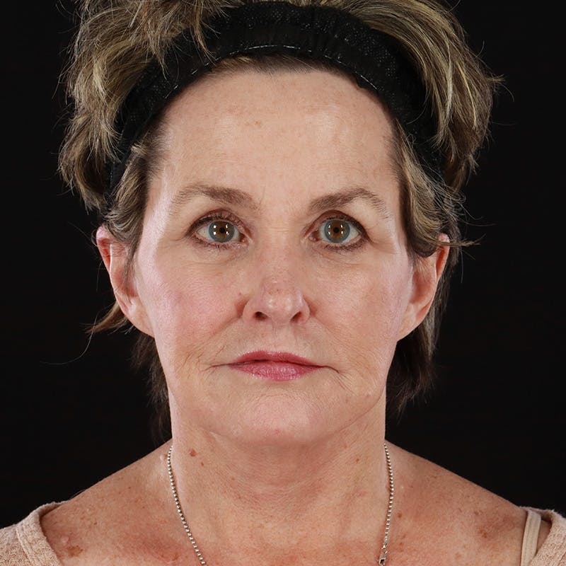 Neck Lift Before & After Gallery - Patient 211207 - Image 4