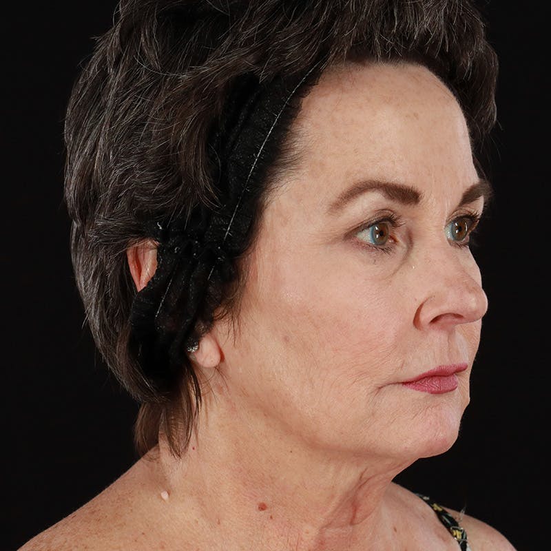 Facelift Before & After Gallery - Patient 135426 - Image 3