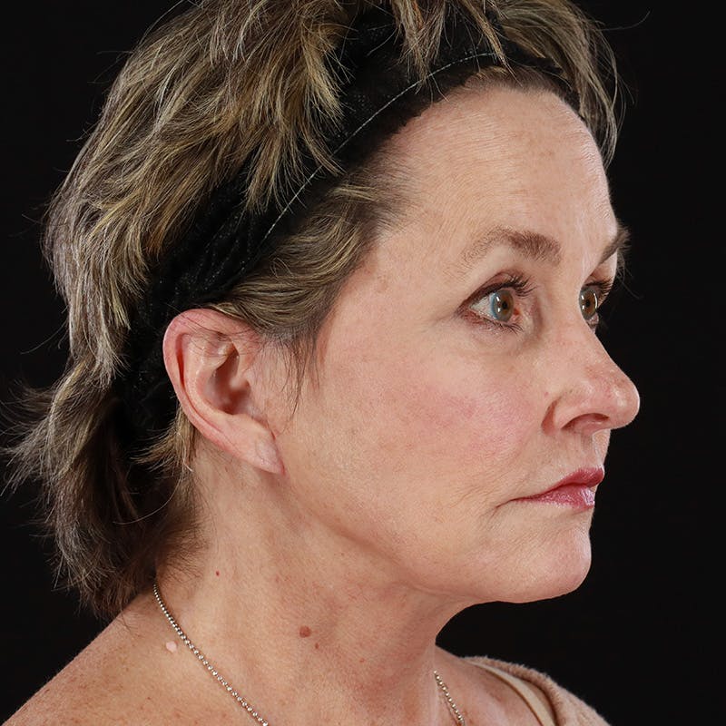 Neck Lift Before & After Gallery - Patient 211207 - Image 6