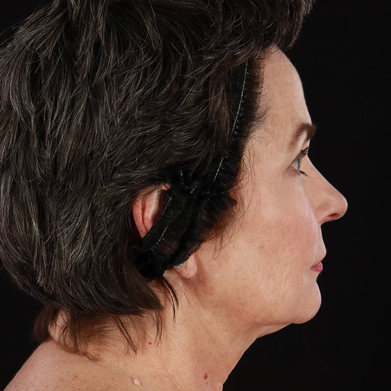 Facelift Before & After Gallery - Patient 135426 - Image 5